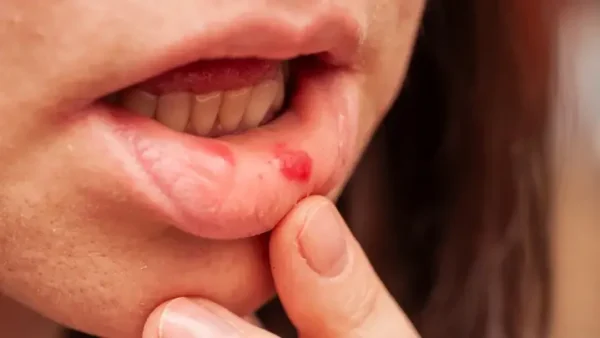 Canker Sore Là Gì? Nguyên Nhân, Triệu Chứng Và Cách Điều Trị Hiệu Quả