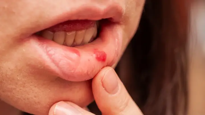 Canker Sore Là Gì? Nguyên Nhân, Triệu Chứng Và Cách Điều Trị Hiệu Quả