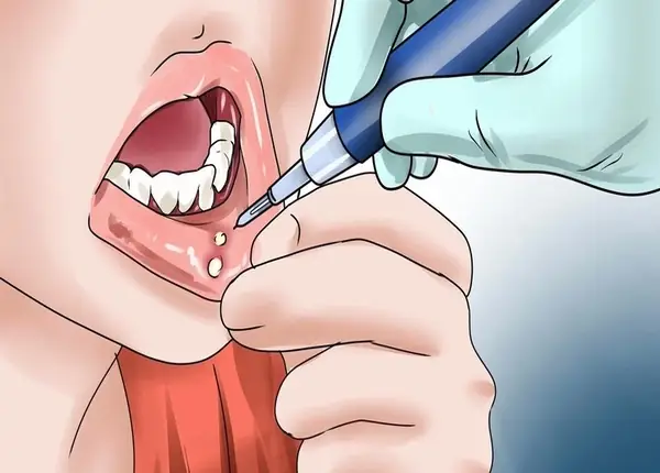 Canker Sore Là Gì? Nguyên Nhân, Triệu Chứng Và Cách Điều Trị Hiệu Quả