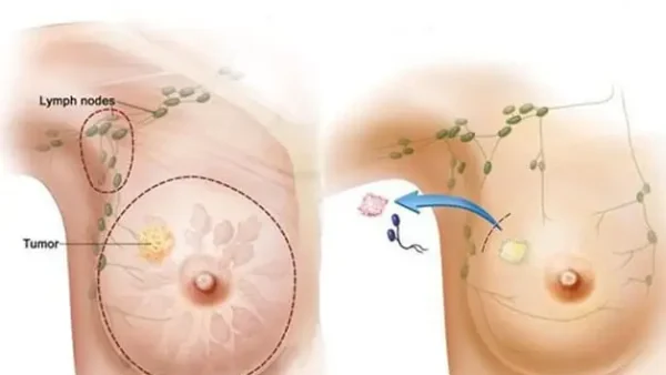 Carcinom Vú Là Gì? Phân Loại, Triệu Chứng Và Các Yếu Tố Liên Quan