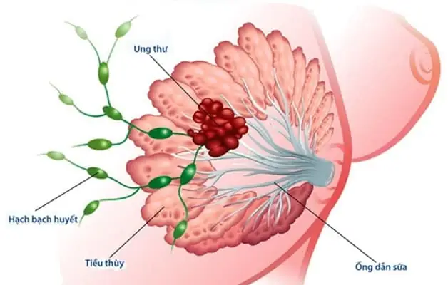 Carcinom Vú Là Gì? Phân Loại, Triệu Chứng Và Các Yếu Tố Liên Quan