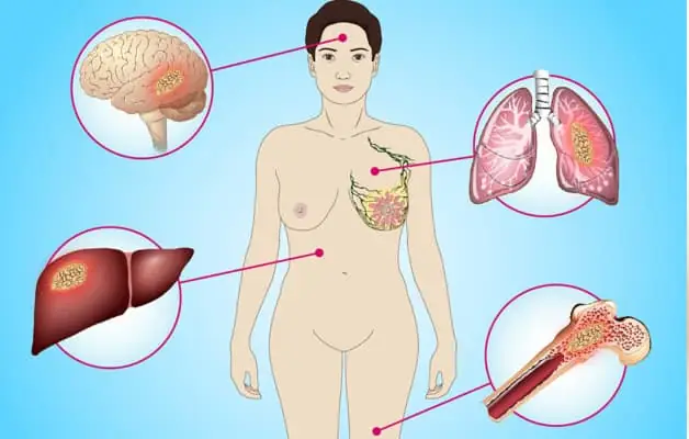 Carcinom Vú Là Gì? Phân Loại, Triệu Chứng Và Các Yếu Tố Liên Quan