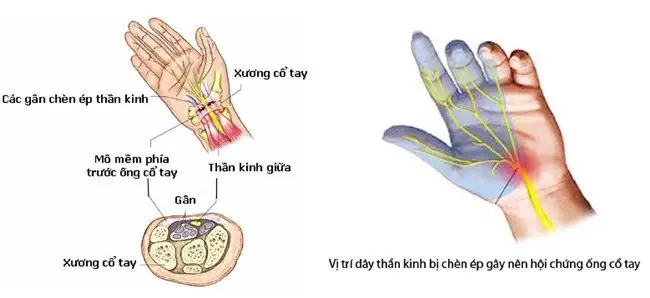 Hội Chứng Ống Cổ Tay (carpal Tunnel Syndrome): Nguyên Nhân, Triệu Chứng, Chẩn Đoán Và Cách Điều Trị Hiệu Quả