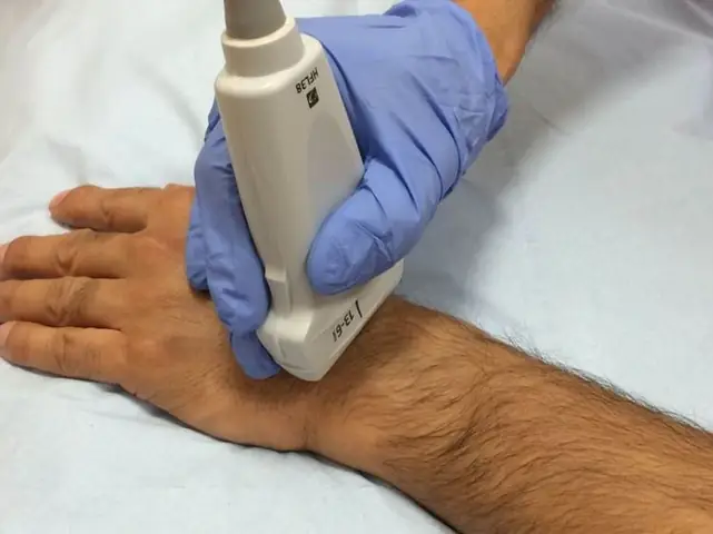 Hội Chứng Ống Cổ Tay (carpal Tunnel Syndrome): Nguyên Nhân, Triệu Chứng, Chẩn Đoán Và Cách Điều Trị Hiệu Quả