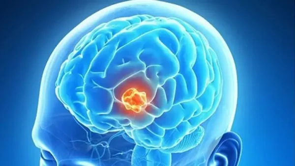 Phù Não Là Gì? Nguyên Nhân, Dấu Hiệu Và Cách Điều Trị Hiệu Quả
