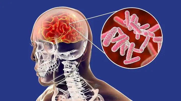 Phù Não Là Gì? Nguyên Nhân, Dấu Hiệu Và Cách Điều Trị Hiệu Quả