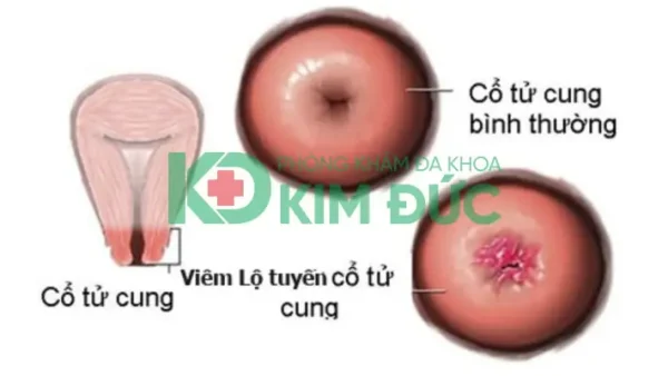 Viêm Lộ Tuyến Cổ Tử Cung (cervical Ectropion) Là Gì? Nguyên Nhân, Dấu Hiệu, Chẩn Đoán Và Cách Điều Trị