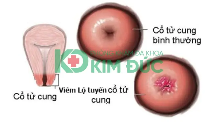 Viêm Lộ Tuyến Cổ Tử Cung (cervical Ectropion) Là Gì? Nguyên Nhân, Dấu Hiệu, Chẩn Đoán Và Cách Điều Trị Viêm Lộ Tuyến Cổ Tử Cung (cervical Ectropion) Là Gì? Nguyên Nhân, Dấu Hiệu, Chẩn Đoán Và Cách Điều Trị