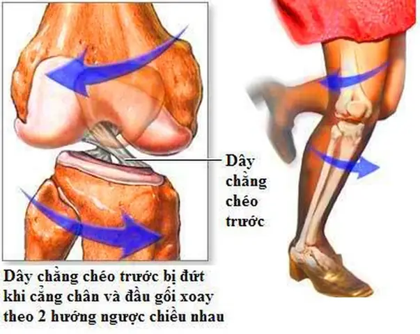 "chăng" Là Gì? Nghĩa Và Cách Dùng Các Từ Có Âm "chăng"