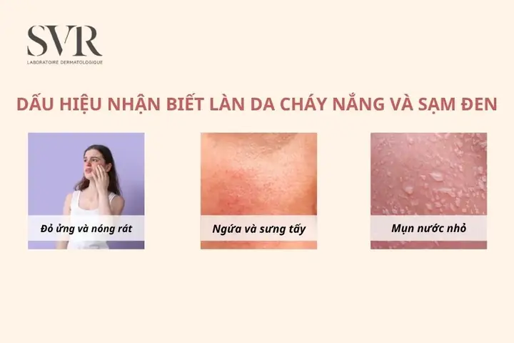 Cháy Nắng Là Gì? Nguyên Nhân, Dấu Hiệu, Cách Xử Lý Và Phòng Ngừa Hiệu Quả
