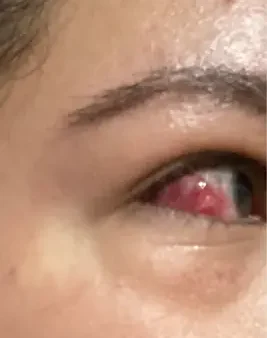 Chemosis Là Gì? Nguyên Nhân, Triệu Chứng Và Cách Xử Trí Phù Kết Mạc Mắt