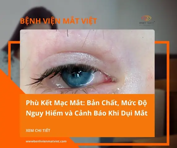 Chemosis Là Gì? Nguyên Nhân, Triệu Chứng Và Cách Xử Trí Phù Kết Mạc Mắt