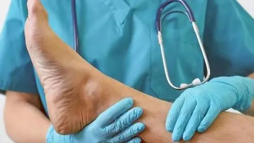 Hội Chứng Chèn Ép Khoang Là Gì? Nguyên Nhân, Triệu Chứng Và Cách Xử Trí