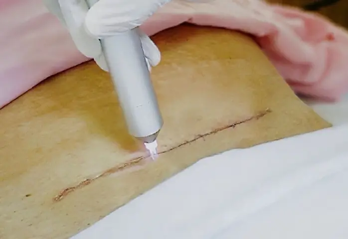 Chiếu Tia Plasma Sau Sinh: Công Dụng, Lợi Ích Và Quy Trình Chăm Sóc Vết Thương