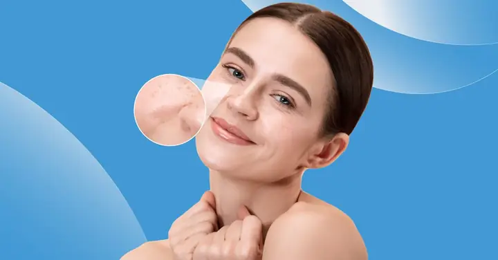 Rám Má (chloasma) Là Gì? Nguyên Nhân, Triệu Chứng Và Cách Nhận Biết Sớm