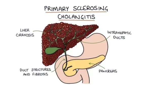 Viêm Đường Mật (cholangitis) Là Gì? Nguyên Nhân, Triệu Chứng Và Cách Điều Trị