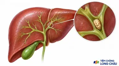 Viêm Đường Mật (cholangitis) Là Gì? Nguyên Nhân, Triệu Chứng Và Cách Điều Trị
